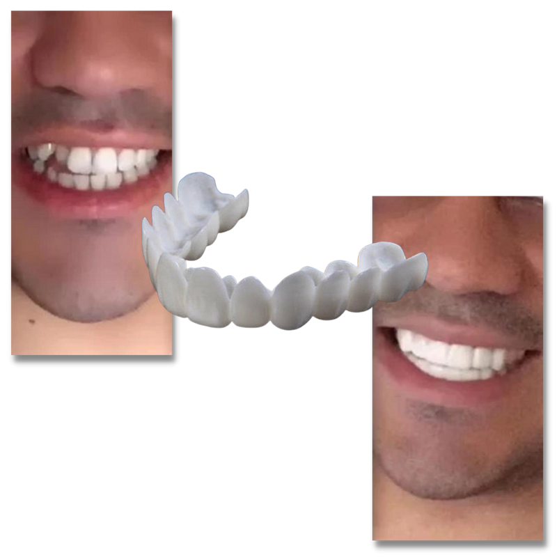 Perfect smile dental coverage - comfortable veneers