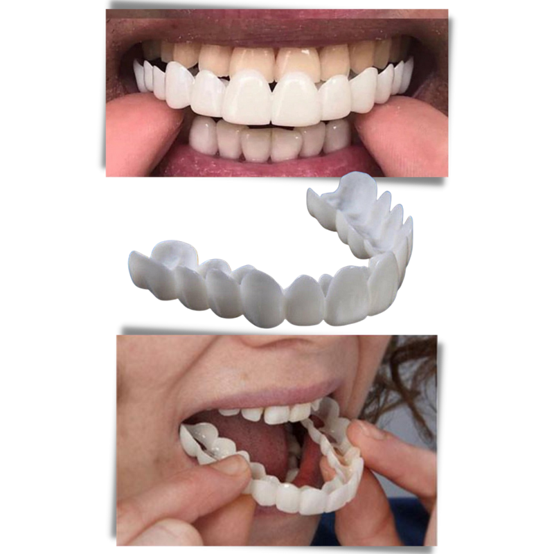 Perfect smile dental coverage - comfortable veneers